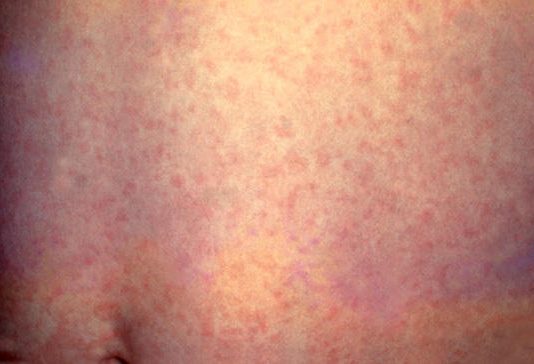 measles : गोवरचा धोका कायम