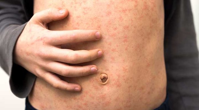 Measles Patient : मुंबई, भिवंडी आणि मालेगाव गोवरचे हॉटस्पॉट