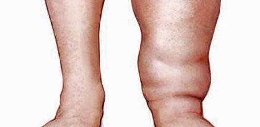 ठाण्यात ४३ मुलांच्या रक्तात आढळले हत्तीरोगाचे सूक्ष्मजीव