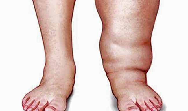 ठाण्यात ४३ मुलांच्या रक्तात आढळले हत्तीरोगाचे सूक्ष्मजीव