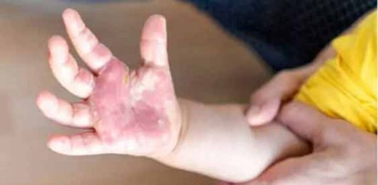 केरळमध्ये पाच वर्षांखालील मुलांना टोमॅटो फ्लूचा संसर्ग