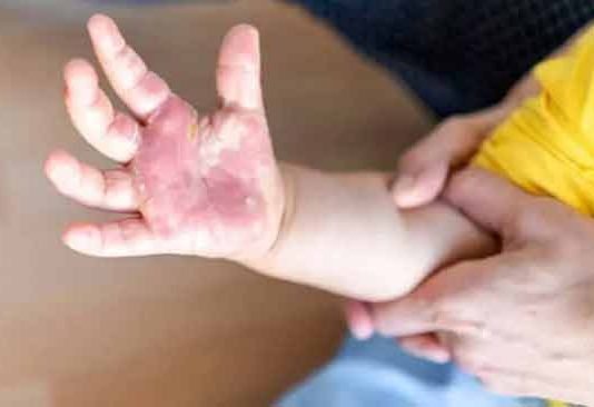 केरळमध्ये पाच वर्षांखालील मुलांना टोमॅटो फ्लूचा संसर्ग