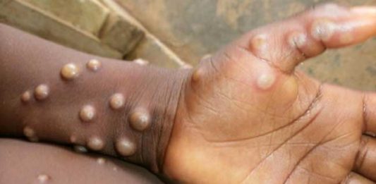 Monkeypox:जगभरात मंकीपॉक्सचा कहर, देशात आढळला संशयित रुग्ण