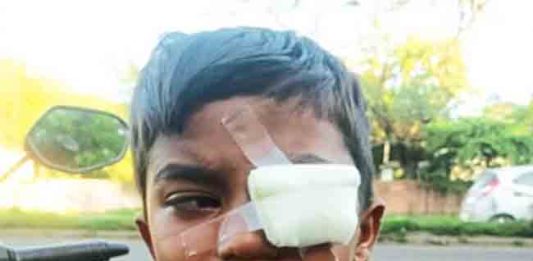 हातात फटाका फुटल्याने डोळ्याला गंभीर दुखापत