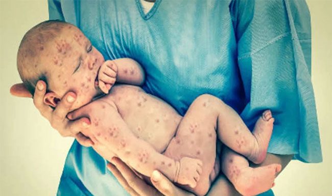 measles : दिवसभरात गोवरच्या ८ नवीन रुग्णांची नोंद; ७१ संशयित रुग्ण