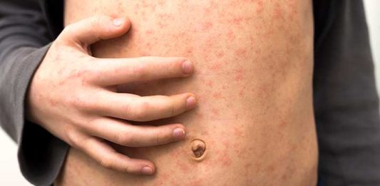 Measles outbreak : कोरोनानंतर महाराष्ट्रावर 'गोवर'चे संकट