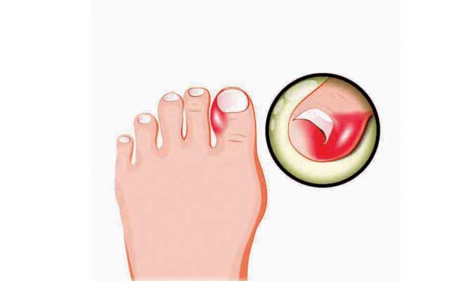 पायाचे नख आतल्या बाजूने वाढणे (इंग्रोन टोनेल)