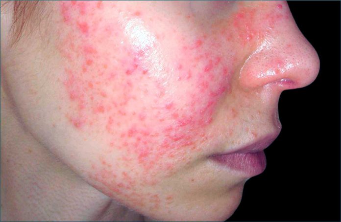 उन्हाळ्यातील त्वचाविकार व त्यांचे उपचार