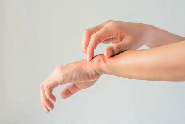 हाताचा इसब/ एक्जिमा (Hand Eczema)