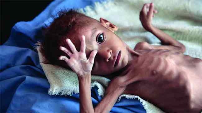 अमरावतीत कुपोषणामुळे ४ महिन्यांत २६९ बालकांचा मृत्यू