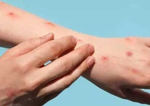 Mpox : मंकीपॉक्सचा वाढता संसर्ग; WHO कडून 'हेल्थ इमरजेंसीची' घोषणा!