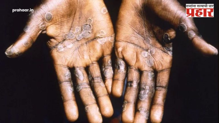 Monkeypox Outbreak: सावधान! जगभरात मंकीपॉक्सचा कहर! जाणून घ्या लक्षणे अन् उपाय