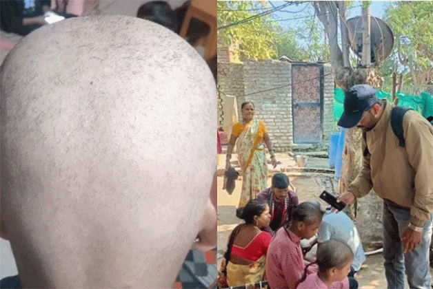 Buldhana Hair Fall Reason : बुलढाण्यातील लोकांचे केस गाळण्यामागे 'हे' आहे कारण