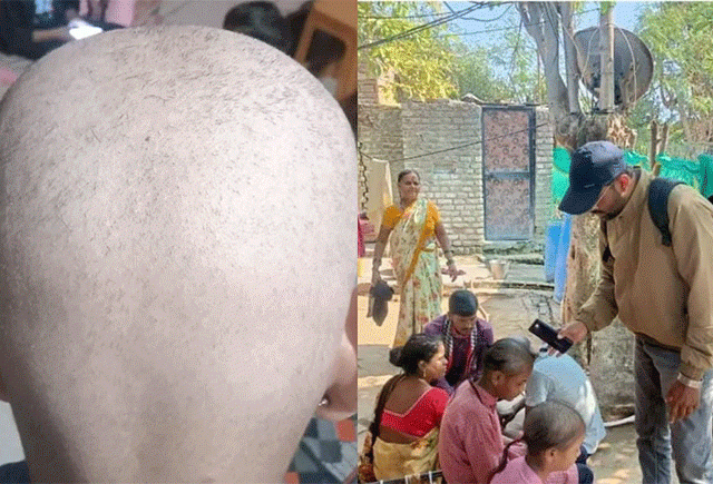 Buldhana Hair Fall Reason : बुलढाण्यातील लोकांचे केस गाळण्यामागे 'हे' आहे कारण