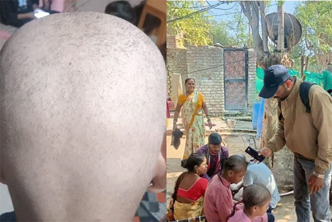 Buldhana Hair Fall Reason : बुलढाण्यातील लोकांचे केस गाळण्यामागे ‘हे’ आहे कारण