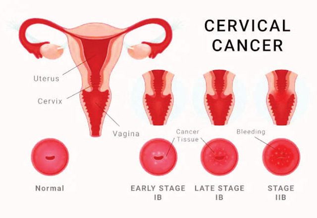 गर्भाशय मुखाच्या कर्करोगाची तपासणी आणि त्याच्या प्रतिबंधाचे महत्त्व