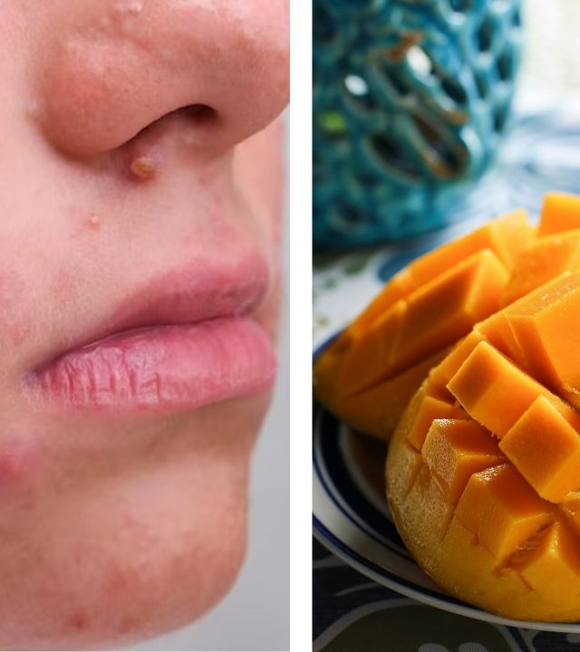 Simple Tricks For Pimple : आंबा खाल्ल्यावर चेहऱ्यावर पिंपल्स येतात? मग 'या' टिप्स आहेत बेस्ट