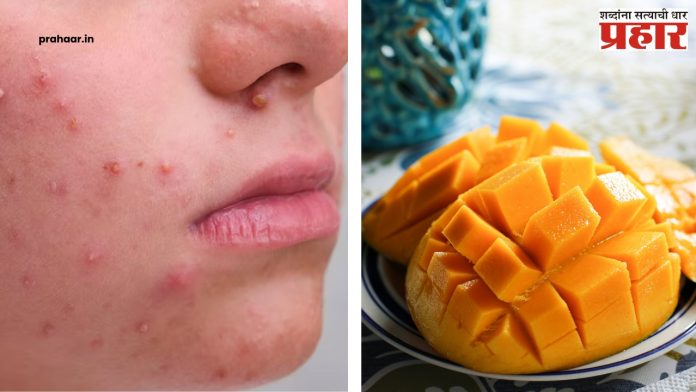 Simple Tricks For Pimple : आंबा खाल्ल्यावर चेहऱ्यावर पिंपल्स येतात? मग 'या' टिप्स आहेत बेस्ट