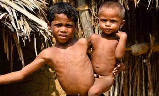 मुंबईत तीव्र कुपोषित बालकांची संख्या चिंताजनक