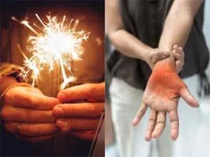 दिवाळीत फटाके फोडताना काळजी घ्या, हात भाजल्यावर काय कराल?