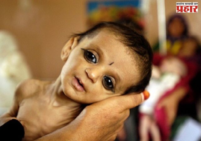 जिल्ह्यात ४५४ बालके कुपोषित