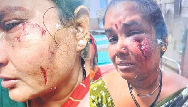 मुंबईतील गोरेगावमध्ये भटक्या कुत्र्यांच्या टोळीने तोडले महिलांच्या गालांचे लचके