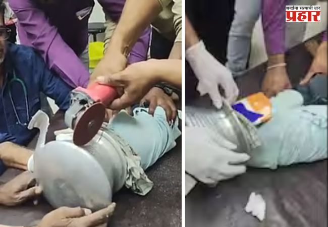Jalgaon: चिमुकलीचं डोकं अडकलं भांड्यात; ११ मिनिटांच्या अथक प्रयत्नानंतर डॉक्टरांना यश