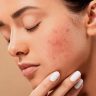 Pimple Solution : चेहऱ्यावर वारंवार पिंपल्स येतात? 'या' सोप्या उपायांनी मिळवा स्वच्छ, नितळ त्वचा