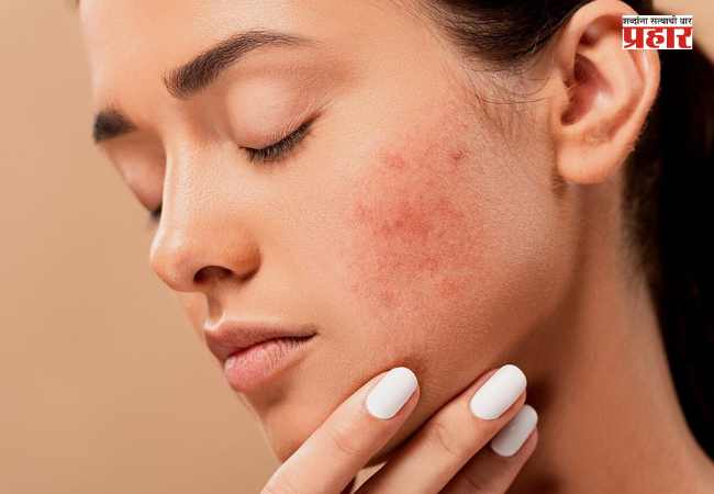 Pimple Solution : चेहऱ्यावर वारंवार पिंपल्स येतात? ‘या’ सोप्या उपायांनी मिळवा स्वच्छ, नितळ त्वचा